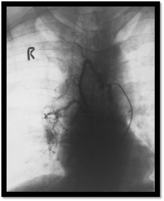 Hypertrophied Bronchial Artery Before Embolisation