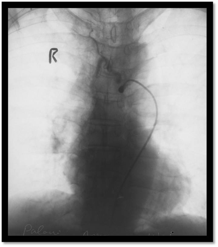 Post Embolisation Image