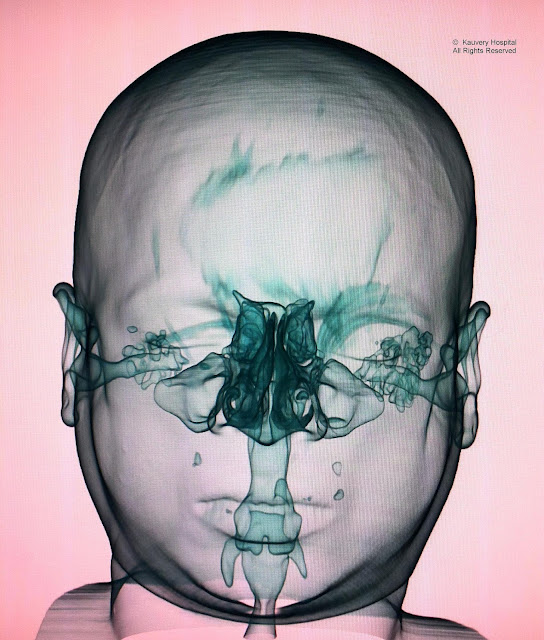 3D Imaging of Upper Respiratory Tract
