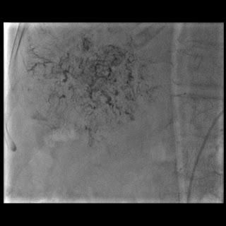 Selective chemoembolization of tumor feeders