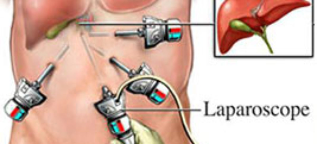 Removal of Gallbladder by Laparoscopy