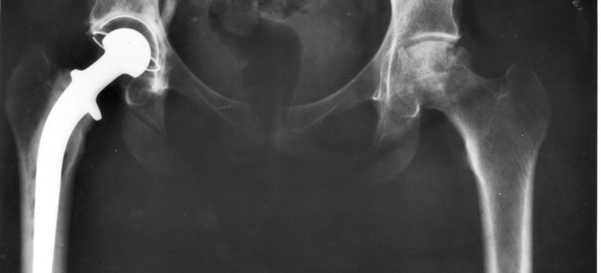 Hip Replacement [Part – 1]