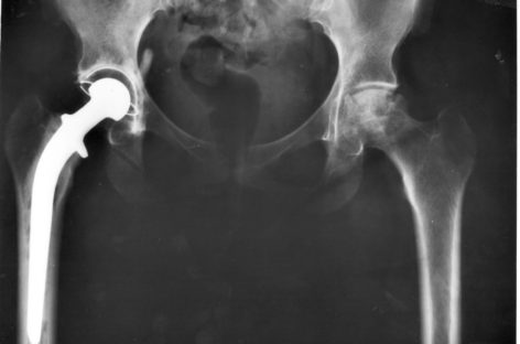 Hip Replacement [Part – 1]
