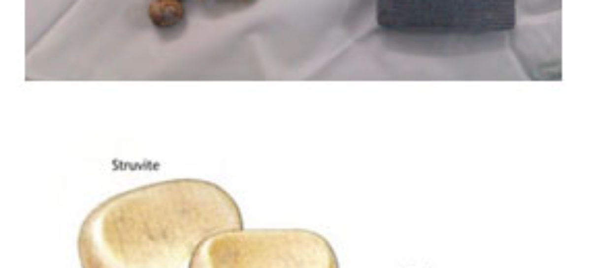 Urinary Stone Disease