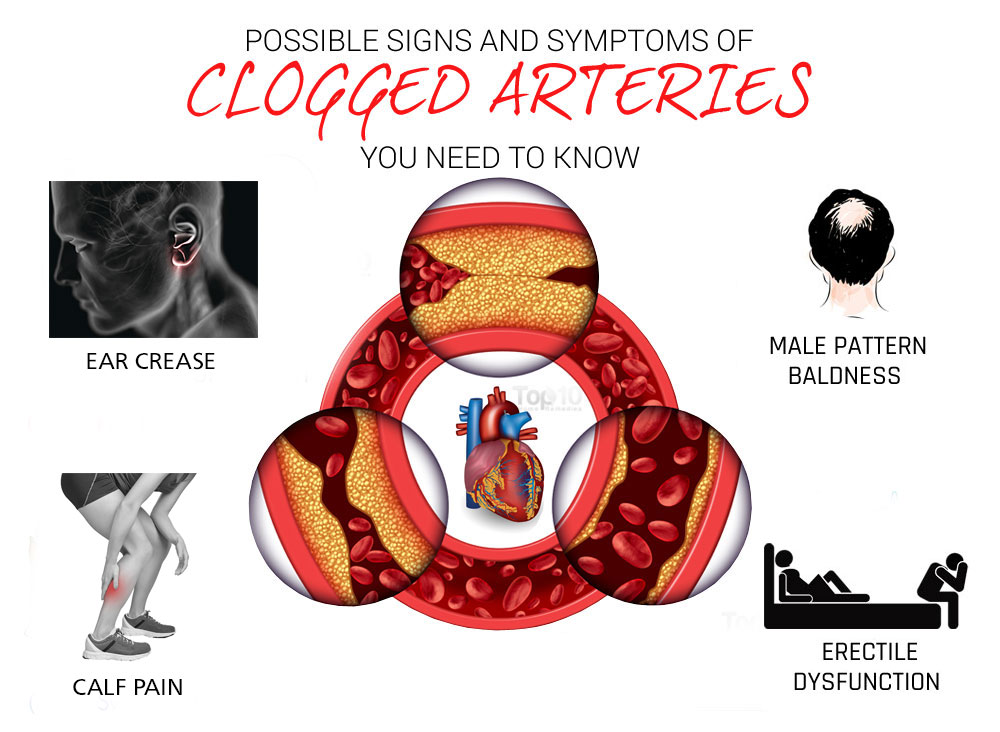 4 Silent Signals for Clogged Arteries