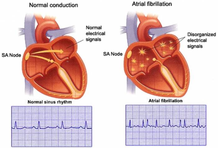 Cardiac Arrhythmia