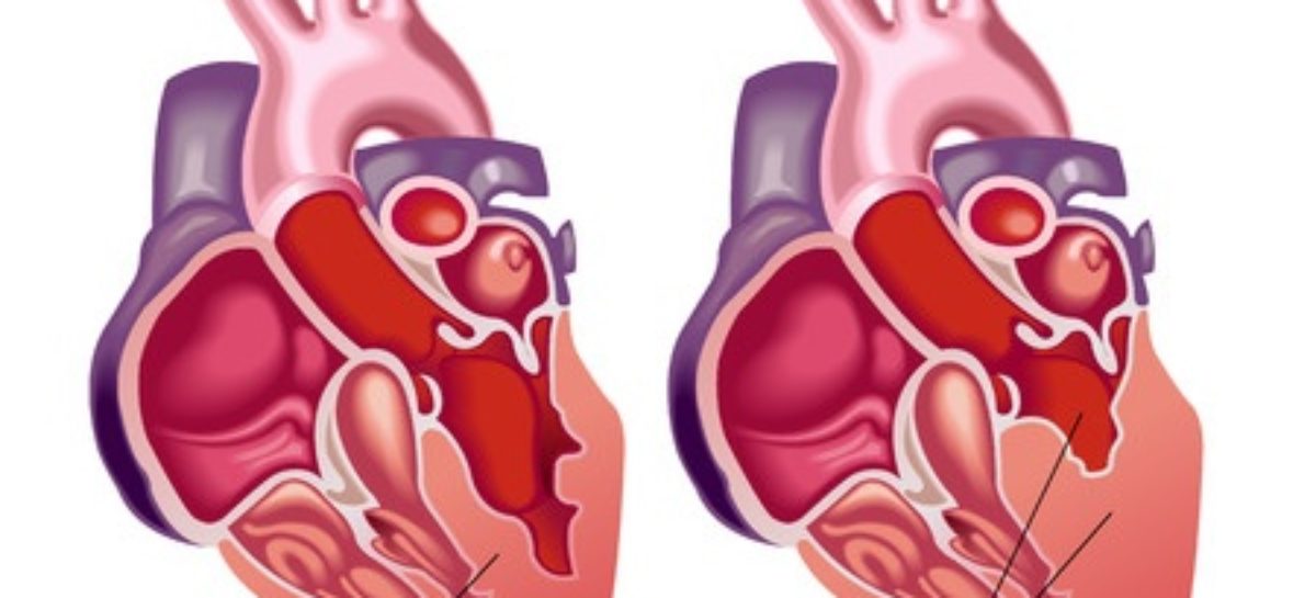 The different stages of Heart Failure