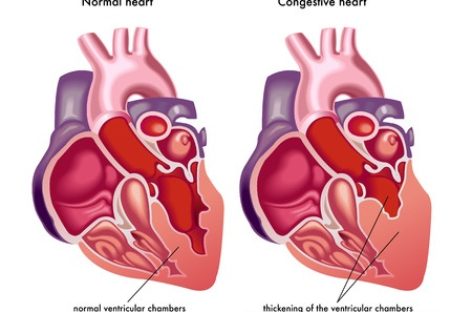 The different stages of Heart Failure
