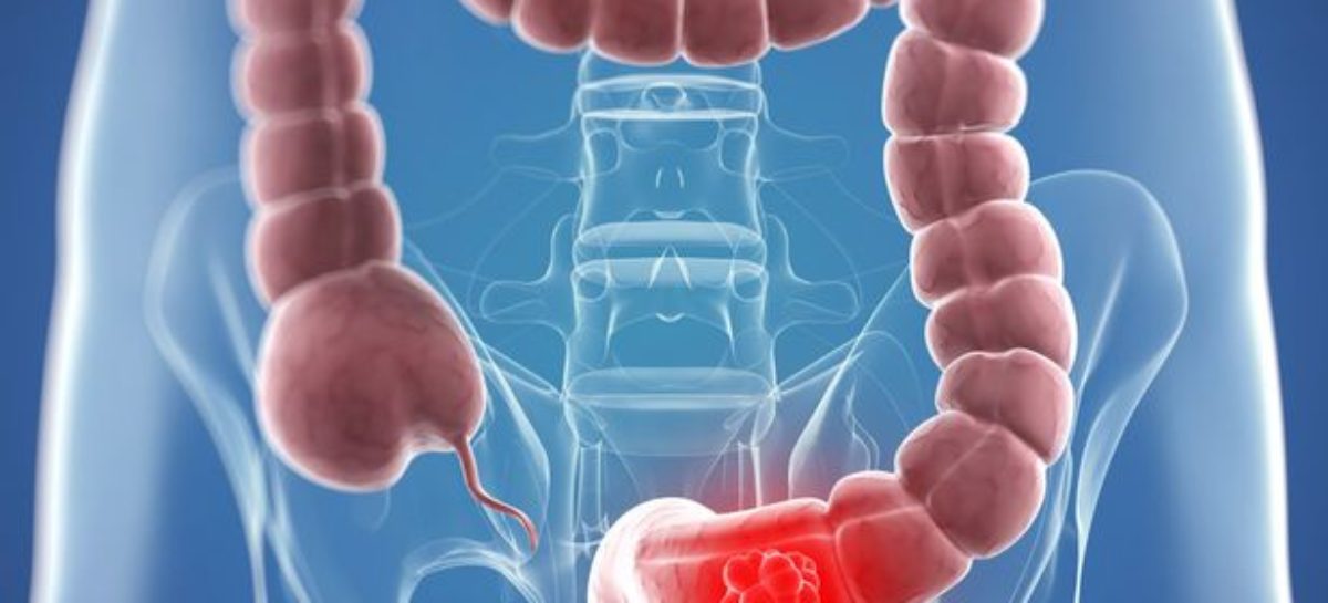 Colon Cancer – The threat is real