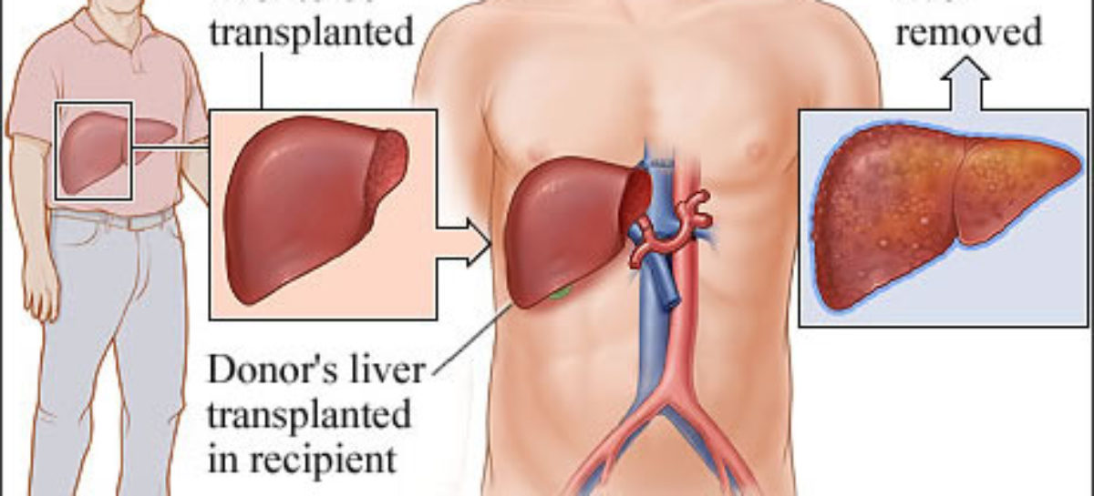 Liver Transplant: Procedure, Types, Cost & Recovery