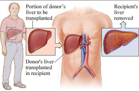 Liver Transplant: Procedure, Types, Cost & Recovery