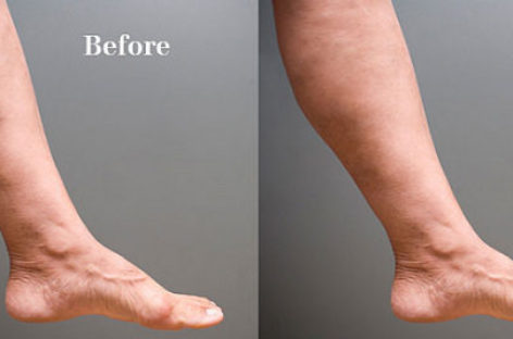 Varicose Veins – Causes And Treatment