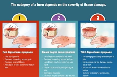 Fire Accident – Emergency Procedures – Infographic