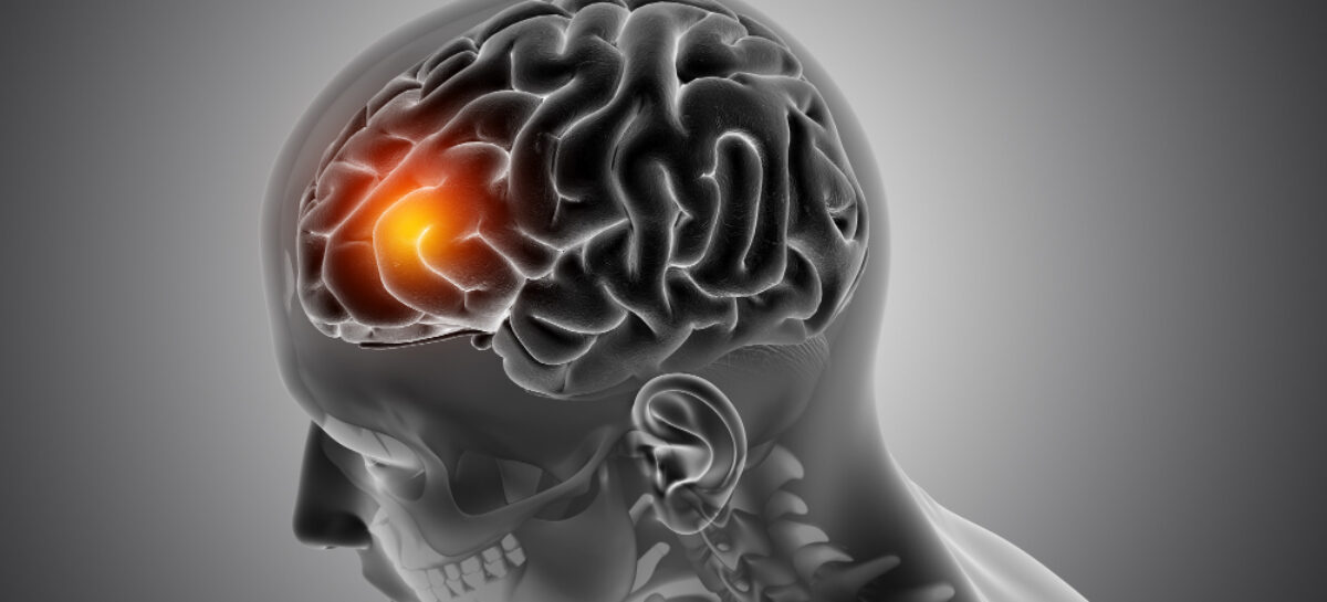 Understanding Meningitis: Causes, Symptoms, Treatment & Prevention