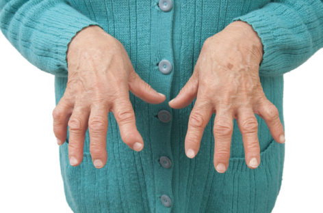 What is Rheumatoid Arthritis?