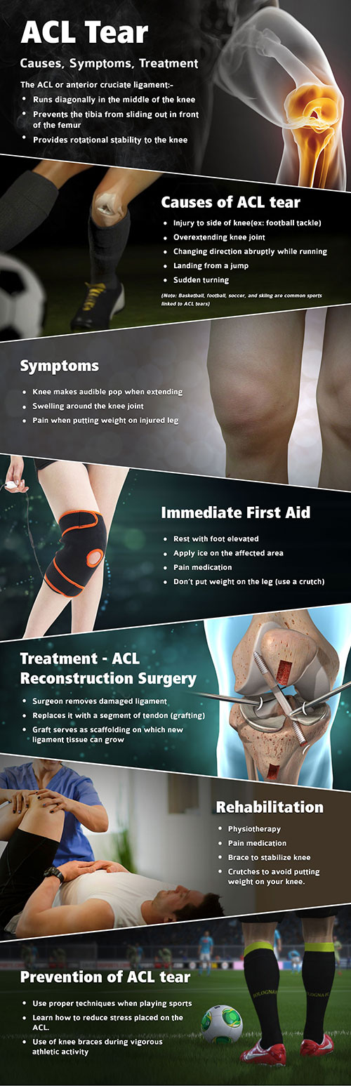 ACL Tear