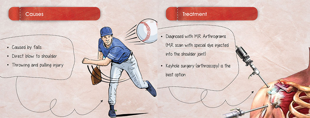 Labral Tears - Causes and Treatment 