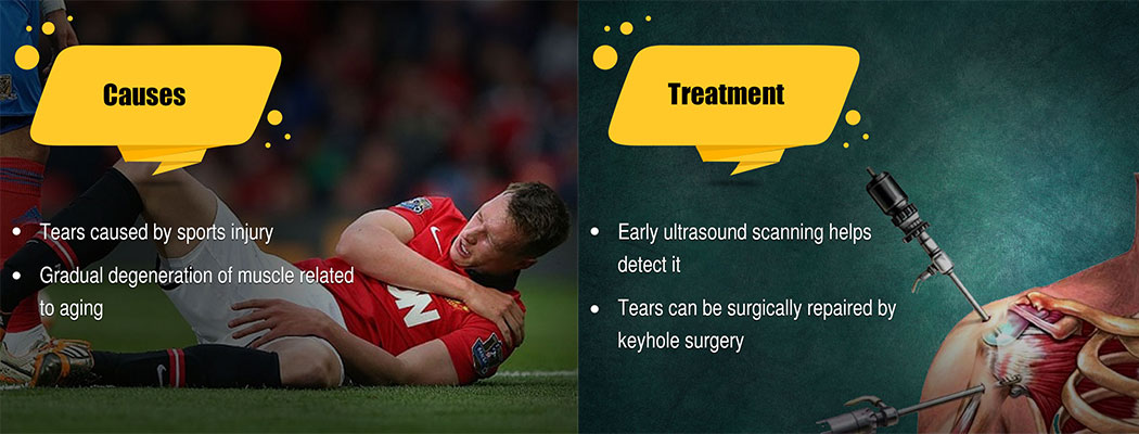 Rotator Cuff Tears - Causes and Treatment 
