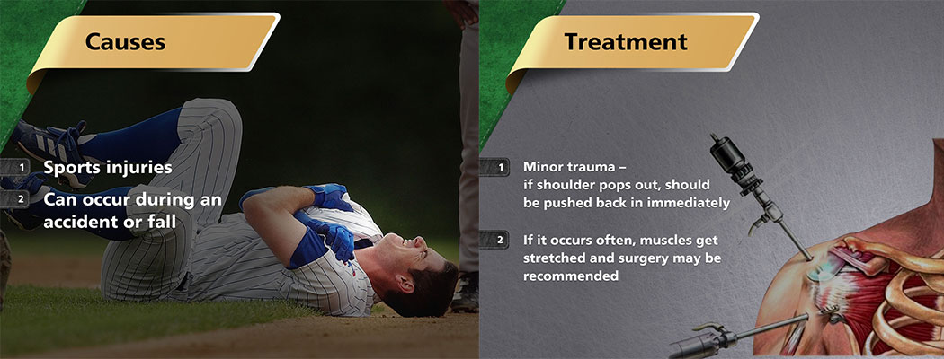 Shoulder Dislocation - Causes and Treatment 
