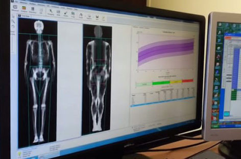 What is a Dexa Scan and how is it done?