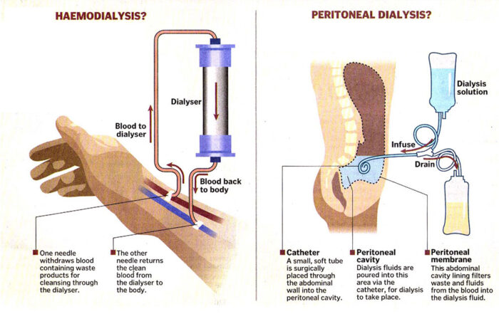 Haemodialysis and Peritoneal Dialysis