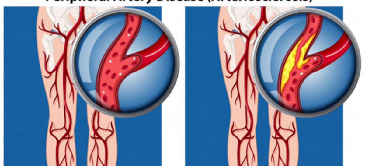Symptoms and Treatment of Peripheral Artery Disease