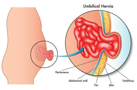 Bulge in your navel? Could be Umbilical Hernia
