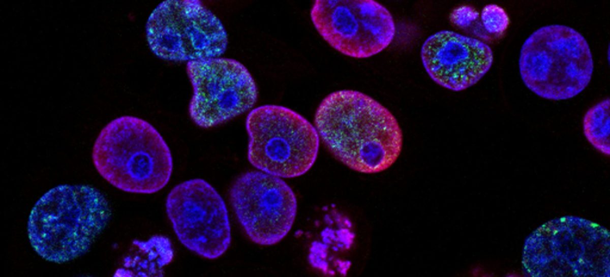 Cancer Treatment During The COVID 19 Pandemic