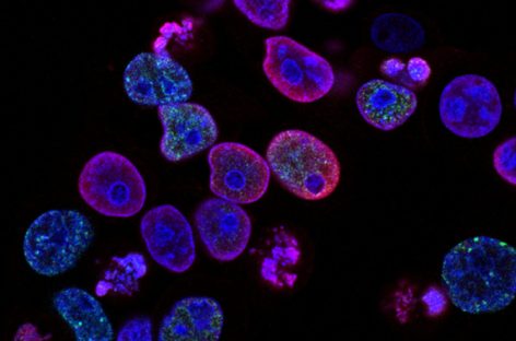 Cancer Treatment During The COVID 19 Pandemic
