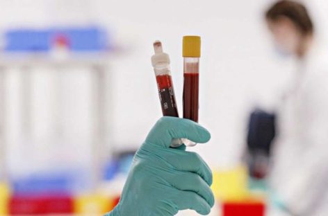 Convalescent Plasma Therapy: A possible cure for Covid-19?