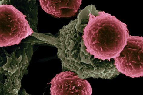 Breast Cancer Early Detection: Myths vs. Facts About Self-Exams and Mammograms