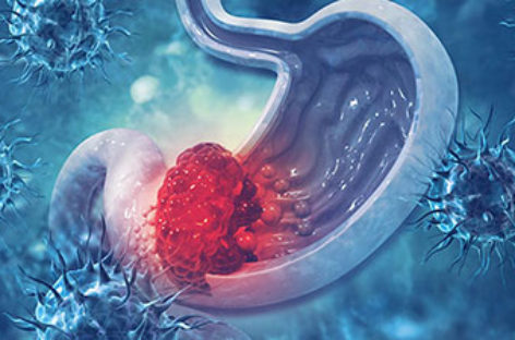 Stomach Cancer: Do not ignore these symptoms