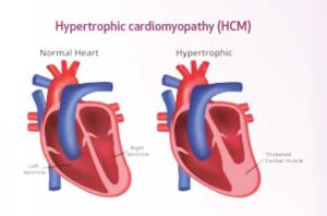 Hypertrophic Cardiomyopathy