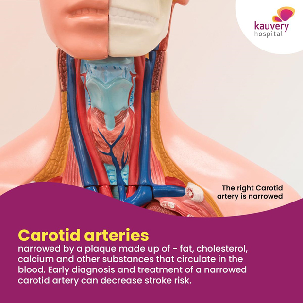 Carotid artery disease - Diagnosis and treatment 