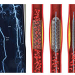 For Limb Salvage 