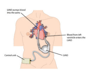 What is Mechanical Circulatory Support?