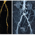 Aortic Disease 