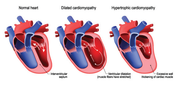 Heart Transplantation