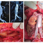Aortic / Peripheral Aneurysm 