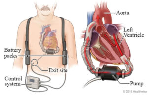 Ventricular Assist Devices