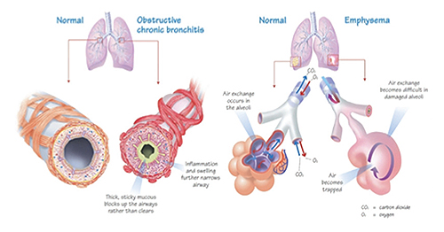 Chronic Obstructive Pulmonary Disease 