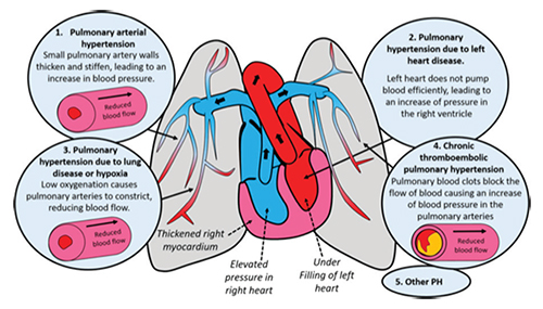 Pulmonary Hypertension 
