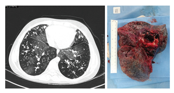 Bronchiectasis
