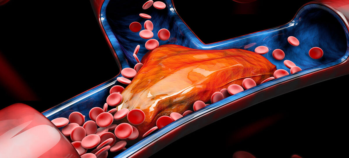 Thrombolysis and Mechanical Thrombectomy