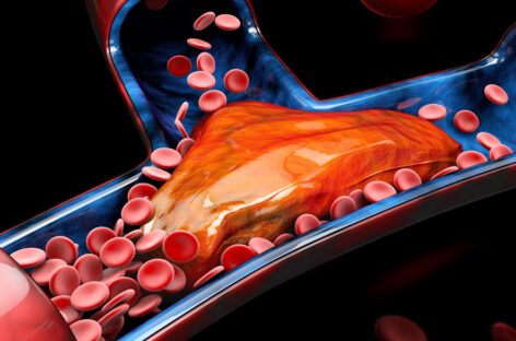 Thrombolysis and Mechanical Thrombectomy