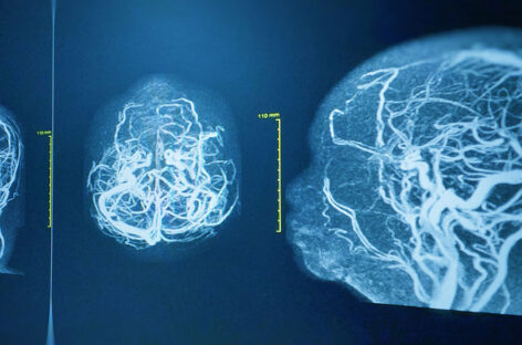 What is a Brain Angiogram and why is it done?