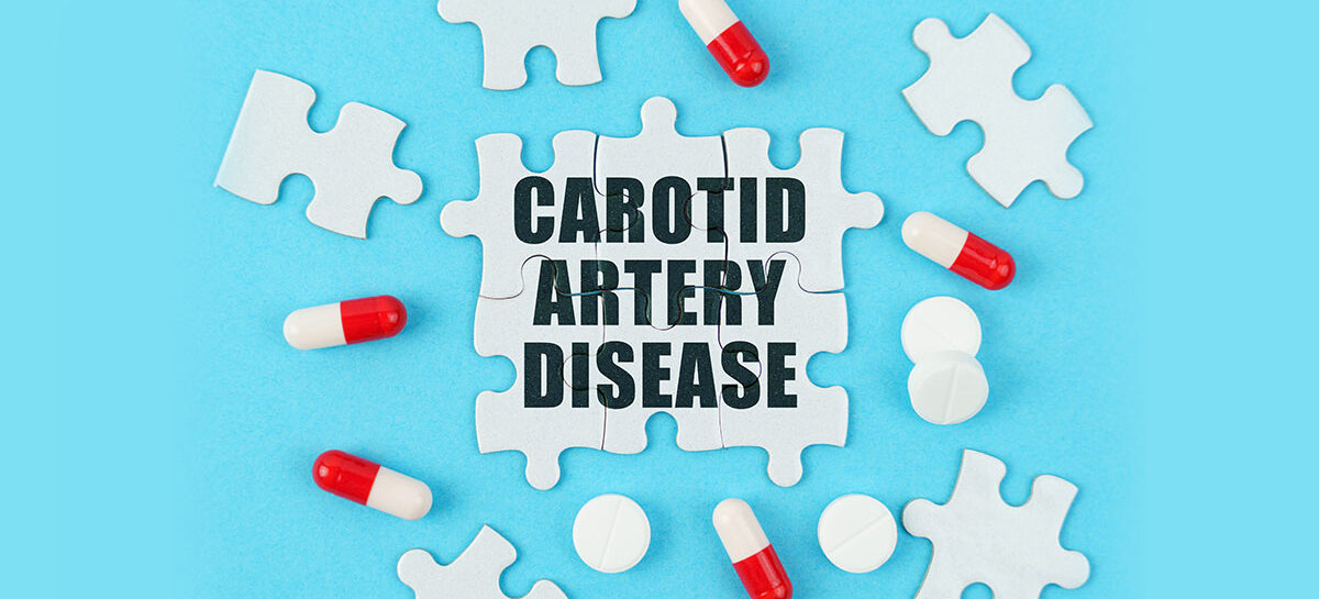 When is Carotid Artery Surgery necessary? What is the success rate?