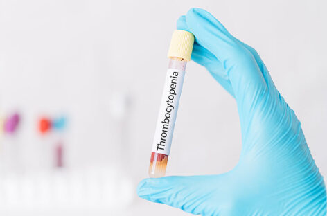Low Platelet Count: Causes, Symptoms and Treatment Options