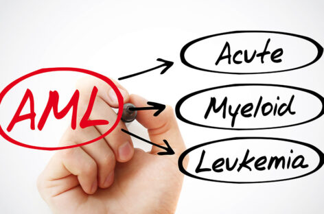 Causes, Symptoms and Treatment of Acute Myeloid Leukaemia
