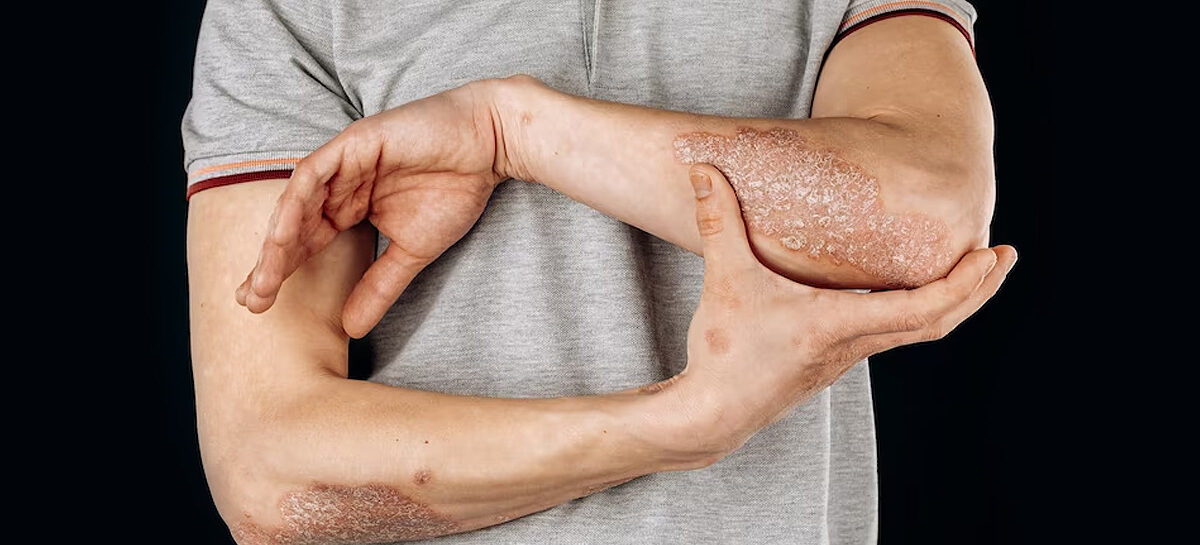 Causes, Symptoms and Treatment for Psoriasis